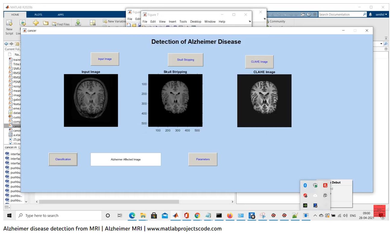 Alzheimer Disease Detection From Mri _ Alzheimer Mri project simulation thumbnail for Signal Processing and AI Engineering