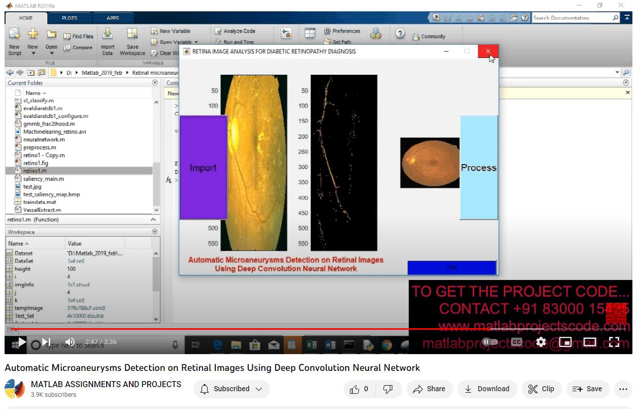 Automatic Microaneurysms Detection on Retinal Images Using Deep ...