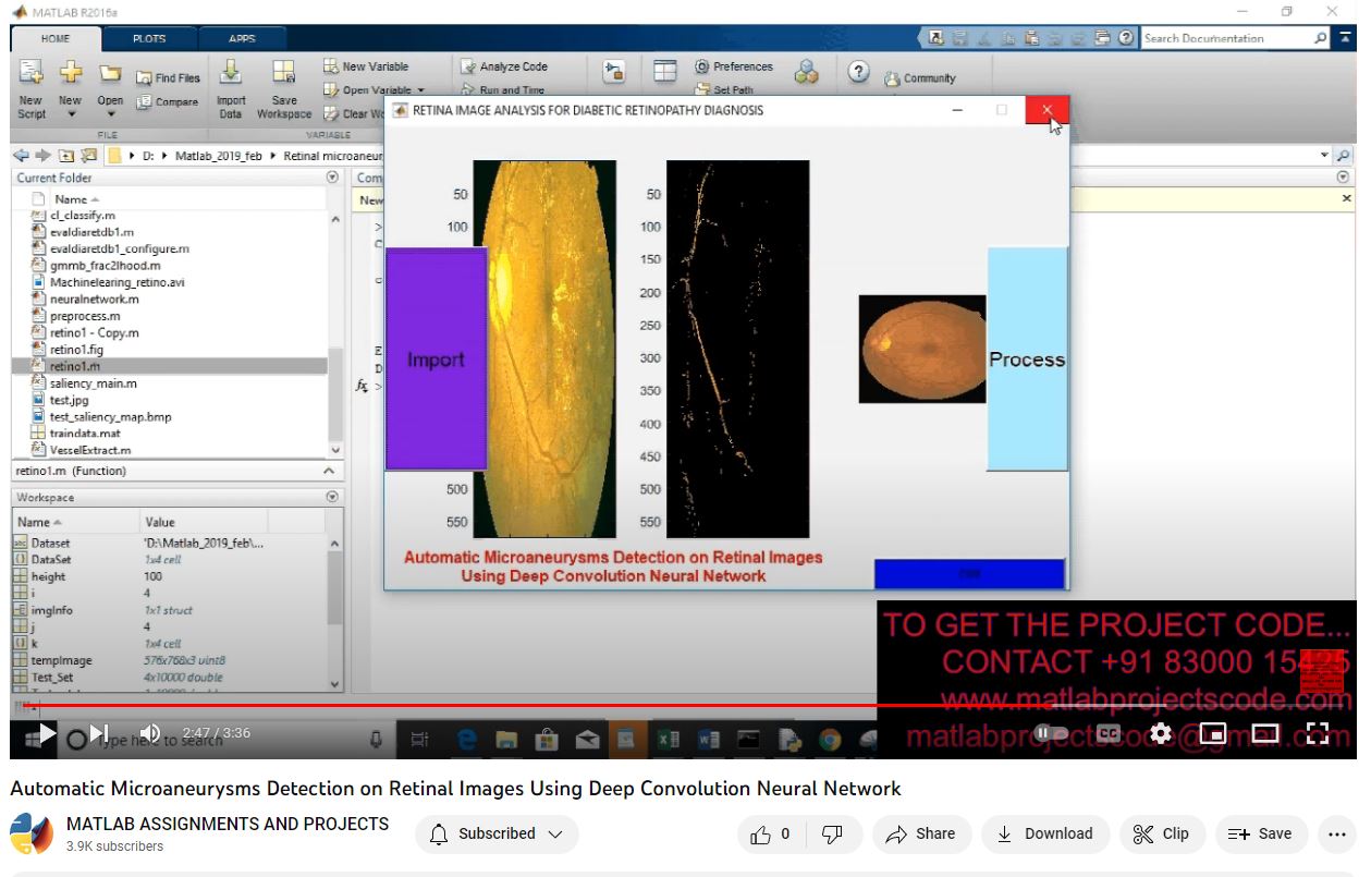 Automatic Microaneurysms Detection On Retinal Images Using Deep Convolution Neural Network project simulation thumbnail for Signal Processing and AI Engineering