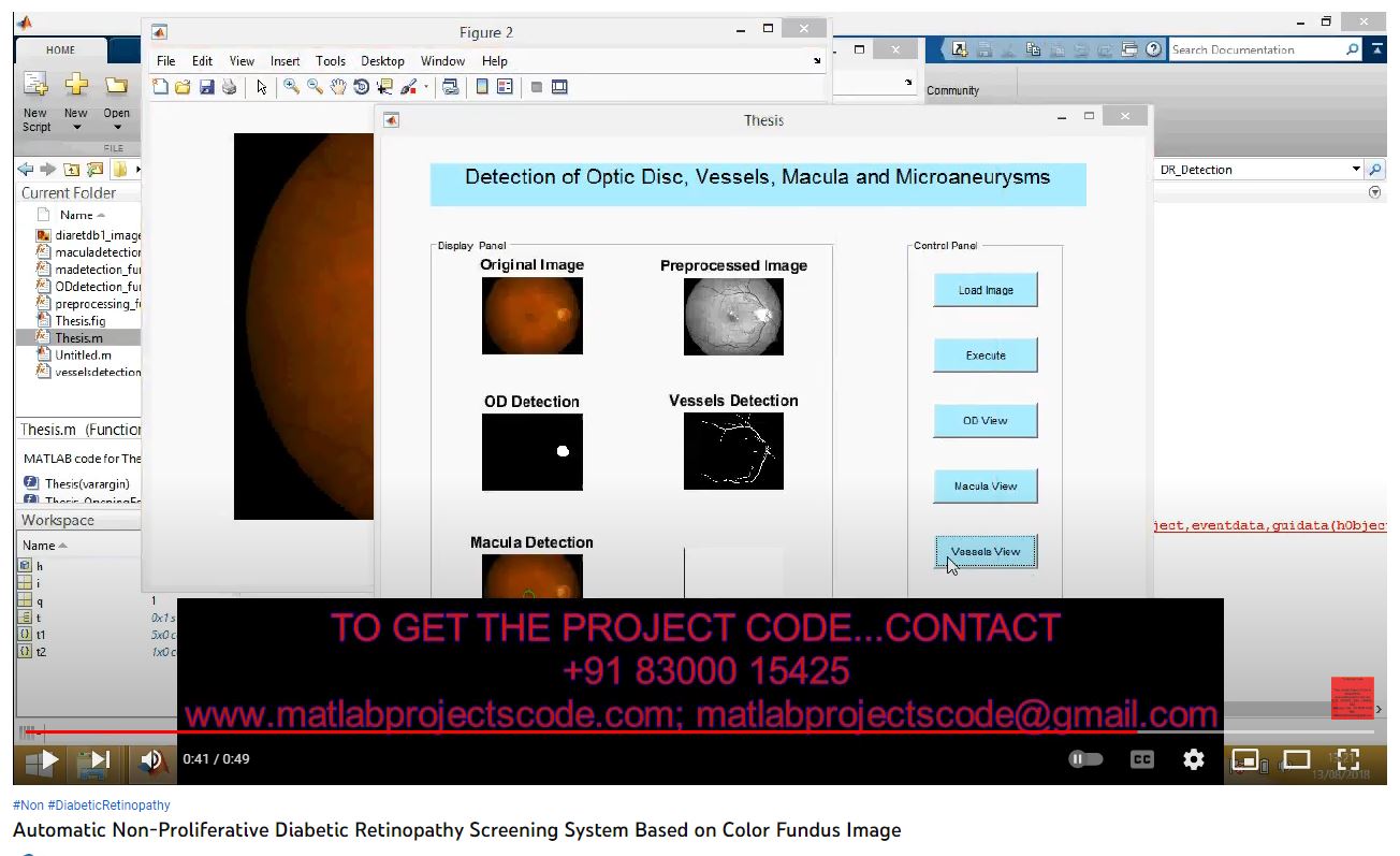 Automatic Non-Proliferative Diabetic Retinopathy Screening System based on Color Fundus Image project simulation thumbnail for Signal Processing and AI Engineering