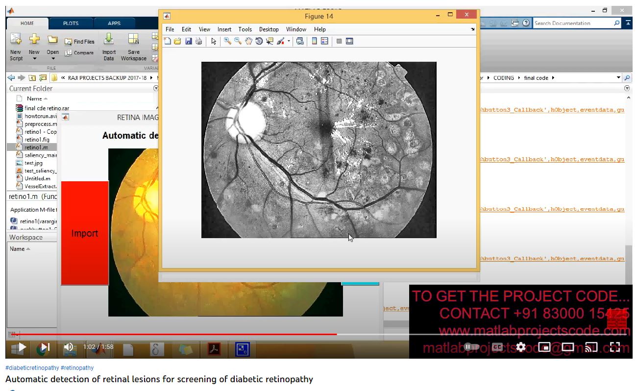 Automatic Detection of Retinal Lesions for Screening of Diabetic Retinopathy project simulation thumbnail for Signal Processing and AI Engineering