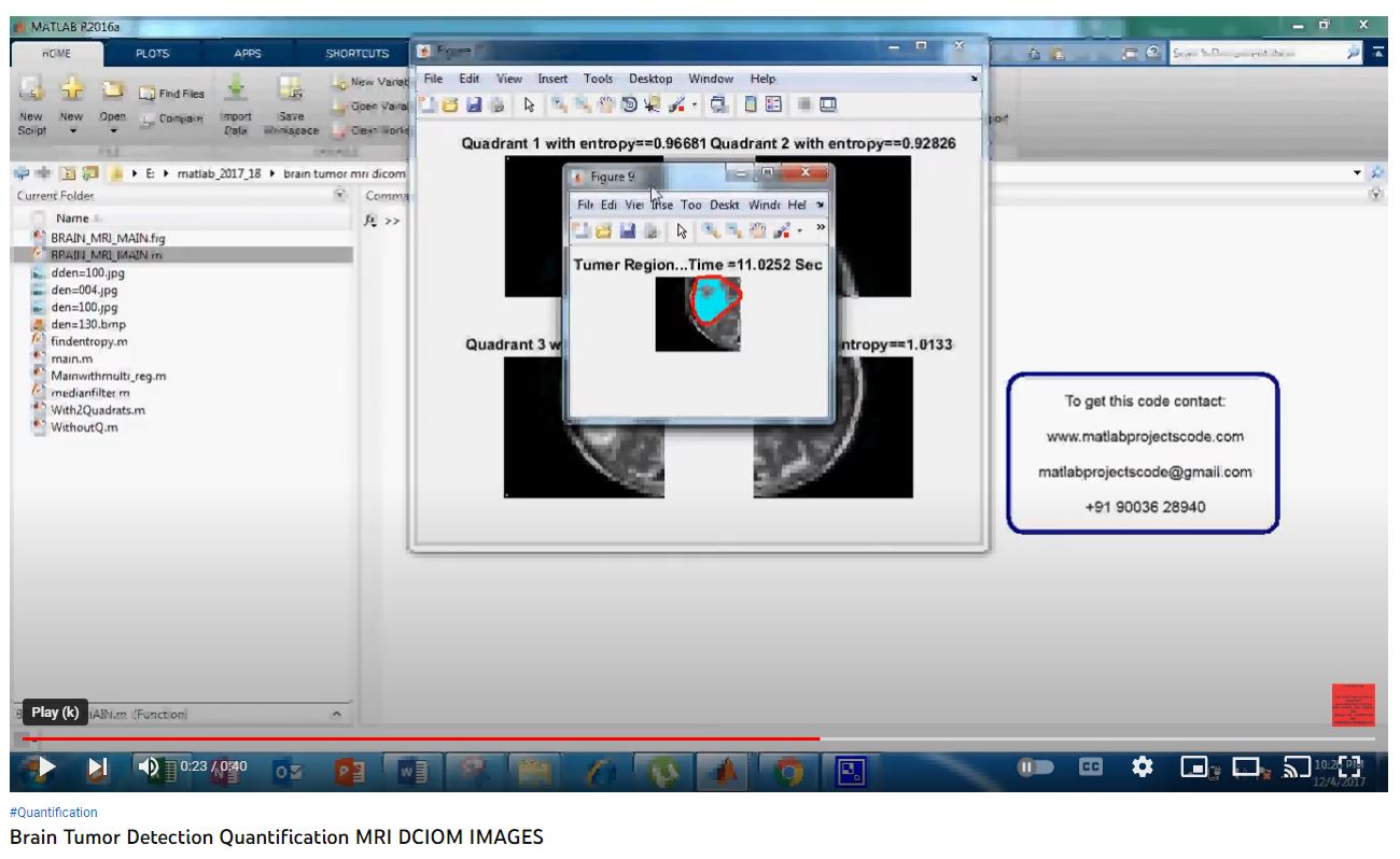 Brain Tumor Detection Quantification MRI DCIOM IMAGES project simulation thumbnail for Signal Processing and AI Engineering
