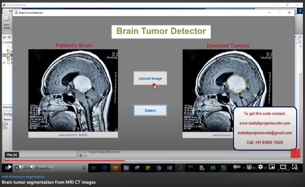 Brain Tumor Segmentation from MRI CT Images project simulation thumbnail for Signal Processing and AI Engineering