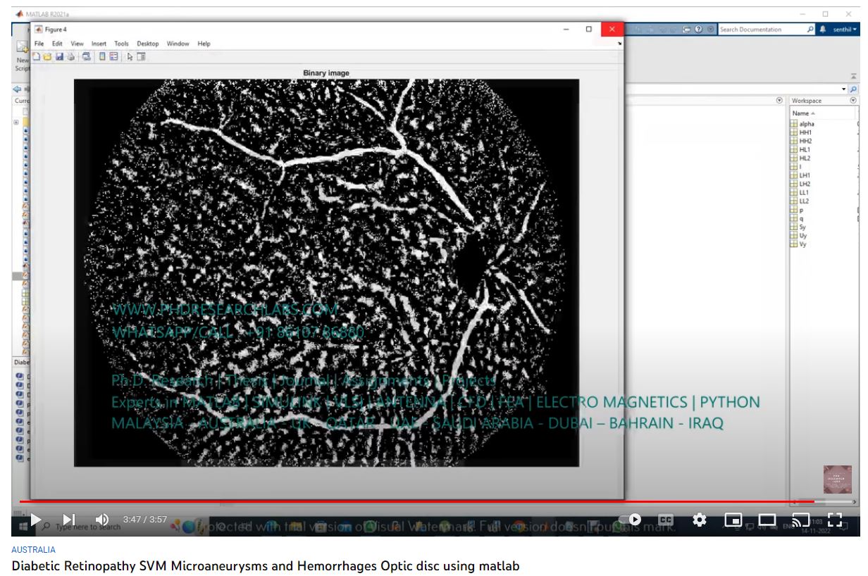 Diabetic_Retinopathy_Svm Microaneurysms Hemorrhages Optic Disc Using Matlab - project thumbnail image