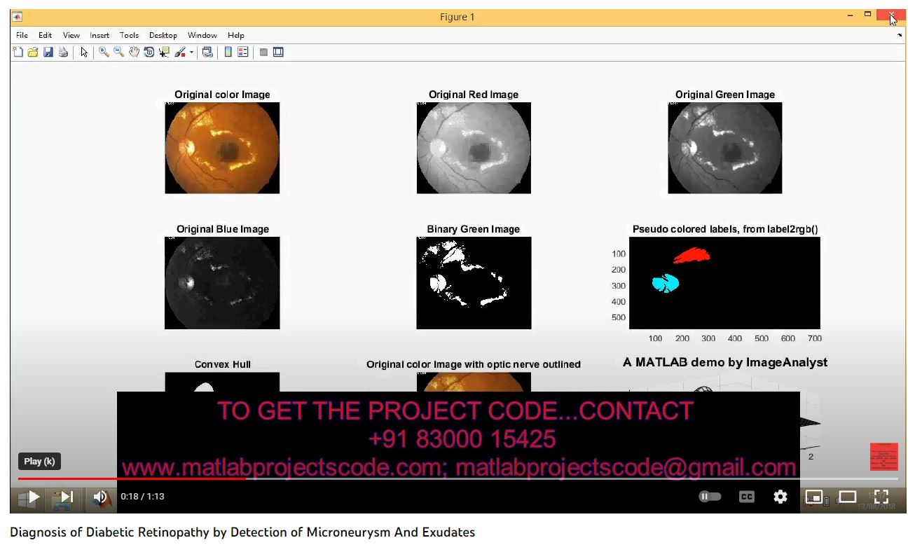 Diagnosis of Diabetic Retinopathy by Detection of Microneurysm and Exudates project simulation thumbnail for Signal Processing and AI Engineering