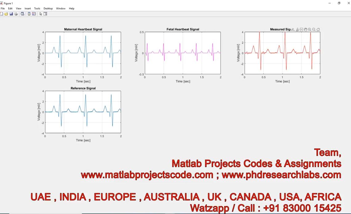 Fetal ECG Extraction Simulink model - FECG - Fetal ECG - MATLAB - ECG ...