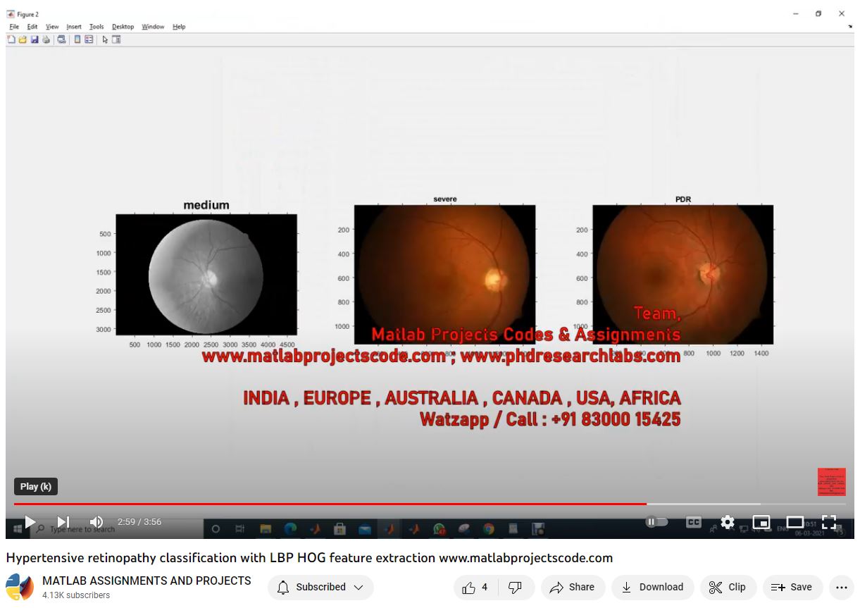 Hypertensive Retinopathy Classification With Lbp Hog Feature Extraction project simulation thumbnail for Mechanical, EV and Mechatronics Engineering