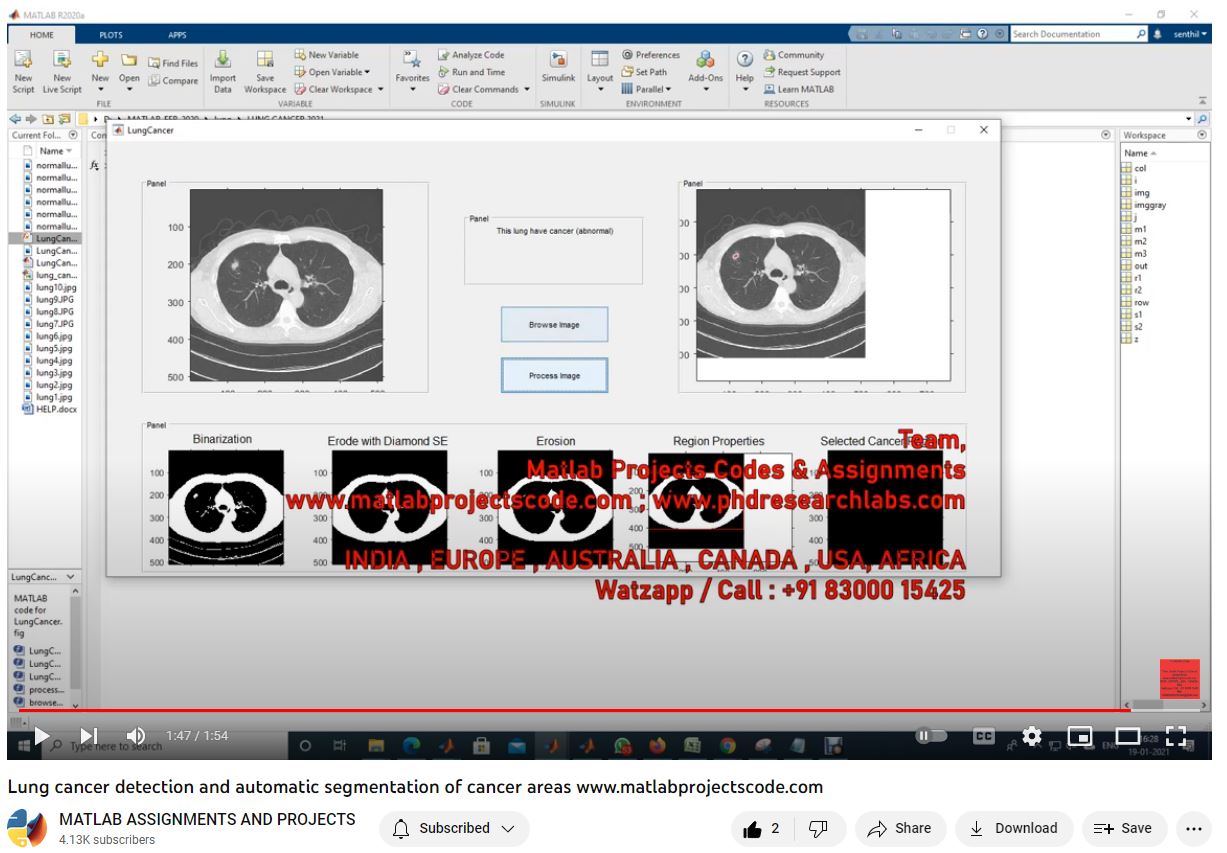 Lung Cancer Detection And Automatic Segmentation Of Cancer Areas project simulation thumbnail for Signal Processing and AI Engineering