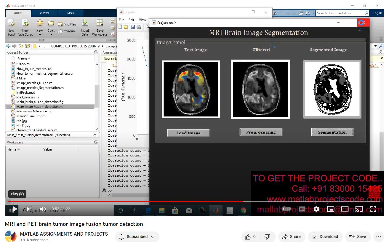 MRI and PET brain tumor image fusion tumor detection