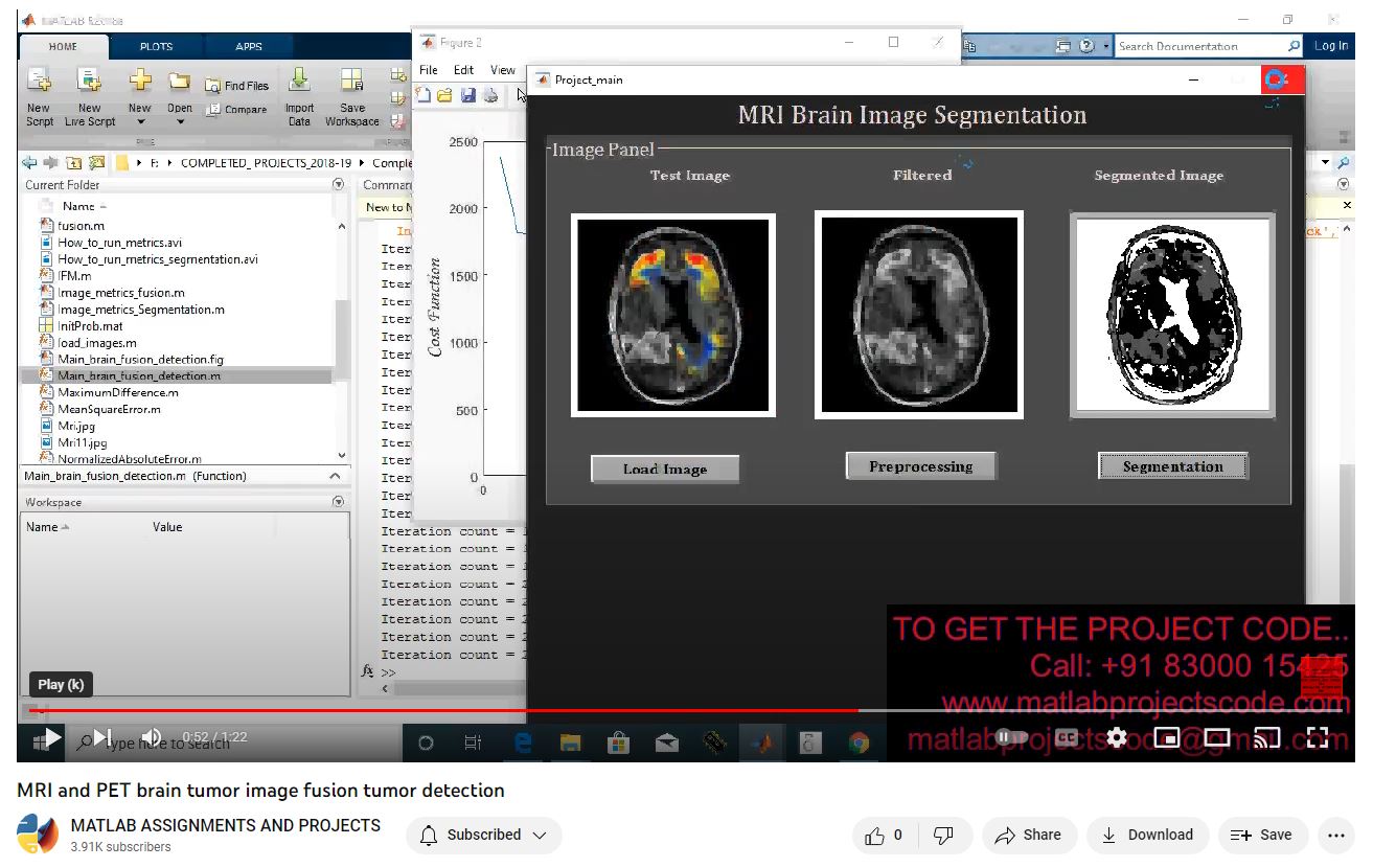 Mri And Pet Brain Tumor Image Fusion Tumor Detection project simulation thumbnail for Signal Processing and AI Engineering