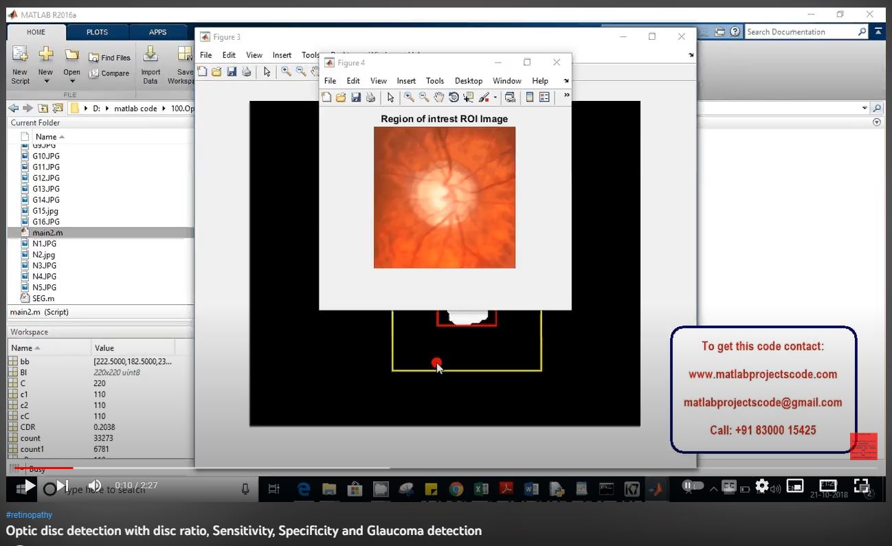 Optic Disc Detection with Disc Ratio, Sensitivity, Specificity and Glaucoma Detection project thumbnail image