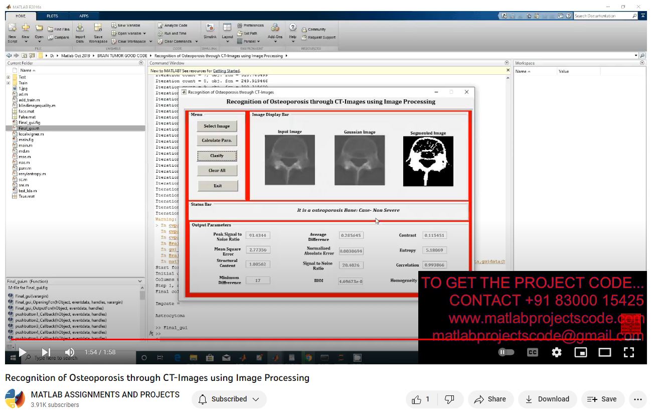 Recognition Of Osteoporosis Through Ct-Images Using Image Processing project simulation thumbnail for Signal Processing and AI Engineering