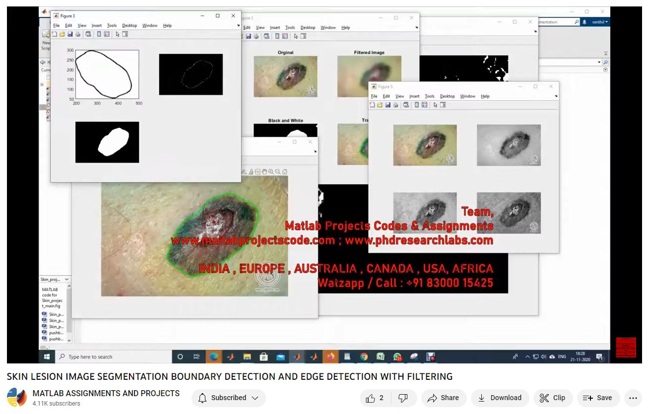 Skin Lesion Image Segmentation Boundary Detection And Edge Detection With Filtering-Matlab Simulink-Electrical Assignments-Projects-Phd Research project simulation thumbnail for Signal Processing and AI Engineering