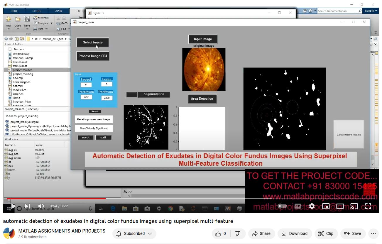 Automatic Detection Of Exudates In Digital Color Fundus Images Using Superpixel Multi-Feature project simulation thumbnail for Signal Processing and AI Engineering