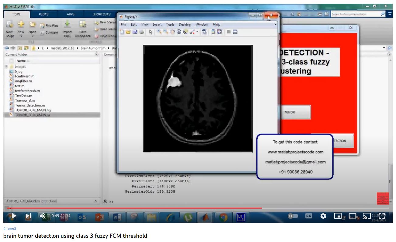 Brain Tumor Detection using Class 3 Fuzzy FCM Threshold project simulation thumbnail for Signal Processing and AI Engineering